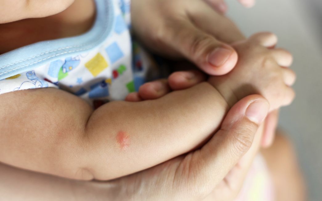 Ubodi komaraca kod djece: kako zaštititi osjetljivu kožu prirodnim putem