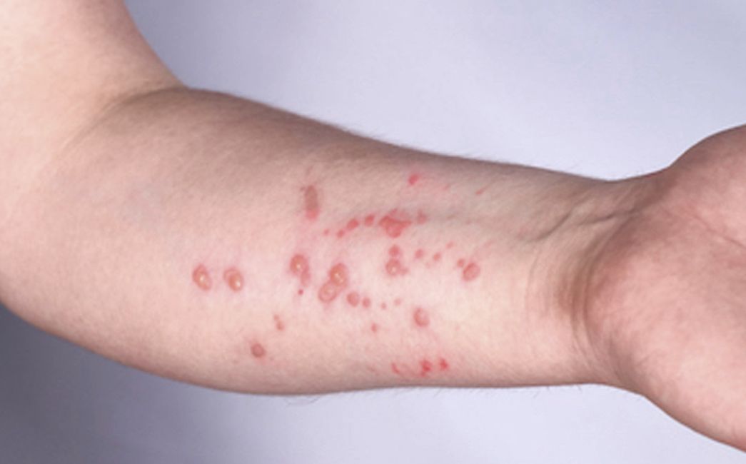    ŠTO JE MPOX? Prijeti li nam nova epidemija majmunskih boginja?